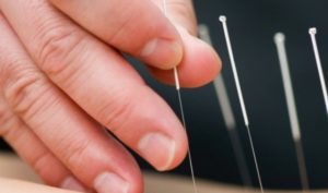 Châm cứu được đến từ đâu và khởi tác dụng trị bệnh như thế nào?