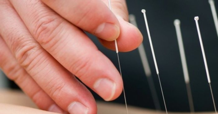 Châm cứu được đến từ đâu và khởi tác dụng trị bệnh như thế nào?
