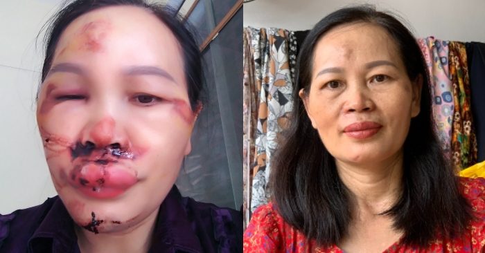 Tai nạn chấn thương vùng mặt, cô thợ may phục hồi nhờ khí công